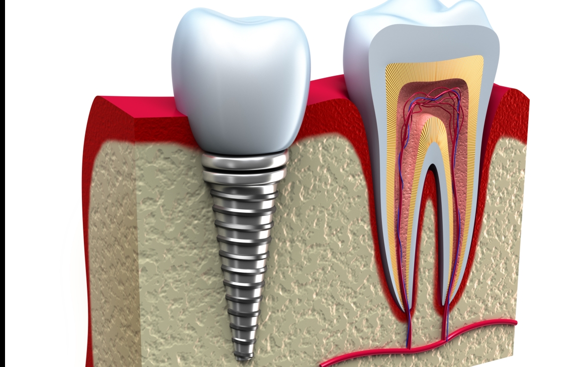 dental-implant